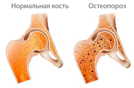 анализ на остеопороз