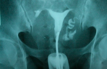 рентгеновский снимок матки