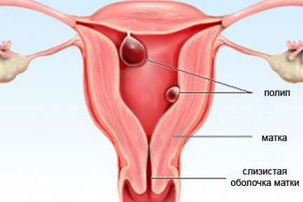 Полипы женских половых органов
