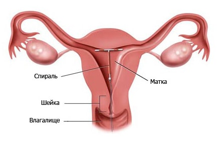 принцип действия внутриматочного контрацептива